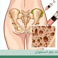 تجربه پیوند مغز استخوان اتولوگ بیمارستان شریعتی