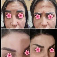 اف یلدایی خدمات ژل و بوتاکس|خدمات آرایشگری و زیبایی|آبادان, |دیوار