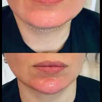 تخفیف ویژه تزریق فیلر بوتاکس مزو ژلprp پلاژن تراپی