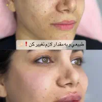 فیلر بادی ،تزریق ژل و بوتاکس با بهترین متریال قیمت|خدمات آرایشگری و زیبایی|دزفول, |دیوار