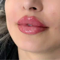 تزریق ژل و بوتاکس در شرق تهران