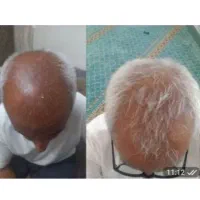 دیگه برای کاشت الکی هزینه نکن