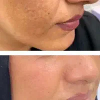 ببمب روشن کنده پوست ولکه