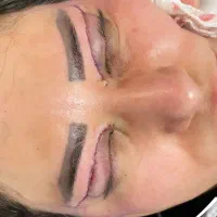 بلفاروپلاستی تخصصی،لیزری