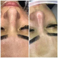 پاکسازی و فیشال پوست