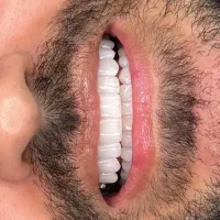 کامپوزیت دندان از ۷م عصب کشی ایمپلنت. دندانپزشکی|خدمات زیبایی و سلامت|تهران, نارمک جنوبی|دیوار