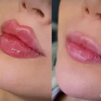 نیازمند مدل تزریق ژل