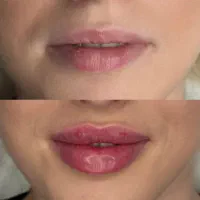 فیلرلب مادلینگ جوانسازی بوتاکس فیلرزیرچشم فیلربادی|خدمات آرایشگری و زیبایی|تهران, سید خندان (جلفا)|دیوار
