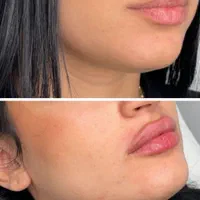تخفیف لیزر و تزریقات ژل ، بوتاکس و مزو|خدمات آرایشگری و زیبایی|تهران, مهران (سیدخندان)|دیوار