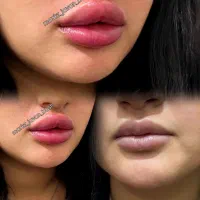 تزریق فیلر بوتاکس انزیم مزو