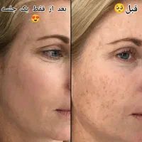 جشنواره درمان تضمینی کک و مک/ زگیل / فقط در 1 جلسه|خدمات آرایشگری و زیبایی|اصفهان, باتون|دیوار