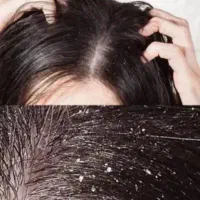 رفع قطعی رشک و شپش در یک جلسه تضمینی