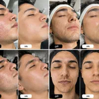 تخفیف ویژه پاکسازی پوست(لایه برداری و جوانسازی)