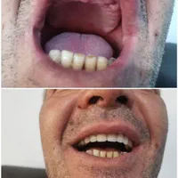 تعمییر وساخت دندان مصنوعی 10 میلیون