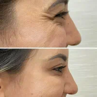 ژل و بوتاکس و برداشتن خال|خدمات آرایشگری و زیبایی|اهواز, زرگان|دیوار