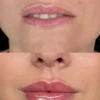 پیرا پزشک هستم اماده همکاری ژل بوتاکس با کلینیک ها