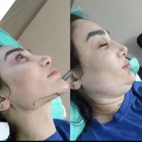 لیپوساکشن غبغب با ویزر و اندولیفت توسط جراح تضمینی|خدمات آرایشگری و زیبایی|مشهد, راهنمایی|دیوار