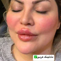 فیلر بادی ،تزریق ژل و بوتاکس با بهترین متریال قیمت|خدمات آرایشگری و زیبایی|دزفول, |دیوار