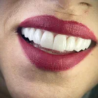 لمینت های دندانی بدون تراش|خدمات آرایشگری و زیبایی|تهران, شهرک ولیعصر جنوبی|دیوار
