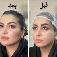 کلینیک تزریق ژل390لیفت بوتاکس لیزر جالپرو پروفایل|خدمات آرایشگری و زیبایی|تهران, صادقیه|دیوار