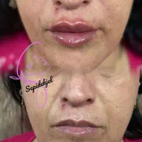 ژل و بوتاکس مزو و انزیم، سیار هستم...|خدمات آرایشگری و زیبایی|قرچک, شهرک طلائیه|دیوار