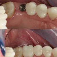 خدمات ایمپلنت دندانپزشکی