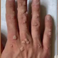 پاکننده خال منگوله و زگیل 3 روزه