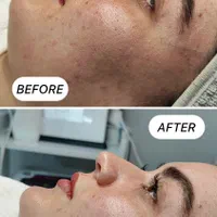پاکسازی،مزونیدلینگ،برداشتن کک ومک،پیرسینگ+آموزش|خدمات آرایشگری و زیبایی|مشهد, سجاد شهر|دیوار