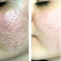 آموزش خدمات پی آرپی،مزوتراپی،بلکسر،فیشال،اسید|خدمات آرایشگری و زیبایی|کرج, گوهردشت|دیوار