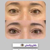 بلفاروپلاستی تخفیف ویژه ساکشن غبغب سوپرکانتورینگ|خدمات آرایشگری و زیبایی|اهواز, کیان اباد|دیوار
