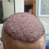 آموزش کاشت مو