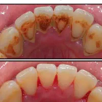 جرم گیری و بروساژ با ۵۰ درصد تخفیف فقط همین امروز