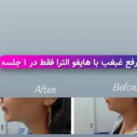 هایفو/لیفت پوست/کانتورینگ صورت/رفع غبغب|خدمات آرایشگری و زیبایی|مسجد سلیمان, |دیوار