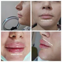 مدل بوتاکس ژل مزوتراپی میکرونیدلینگ فشیال|خدمات آرایشگری و زیبایی|فردیس, طالقانی|دیوار