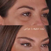 تزریق ژل بوتاکس نخ ...توسط پزشک در کلینیک سایماه|خدمات آرایشگری و زیبایی|کرمان, |دیوار