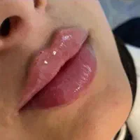 تزریق ژل بوتاکس مزوتراپی سر وصورت