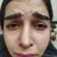 ژل بوتاکس مزو|خدمات آرایشگری و زیبایی|صدرا-فارس, فاز ۱|دیوار