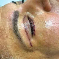 بلفاروپلاستی تخفیف ویژه ساکشن غبغب سوپرکانتورینگ|خدمات آرایشگری و زیبایی|اهواز, کیان اباد|دیوار