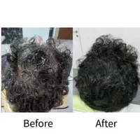 رویش تضمینی مو با تکنیک پیشرفته مزوتراپی