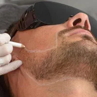 لیزر موهای زائد فسا پاک کردن تتو پلاژن تراپی|خدمات آرایشگری و زیبایی|فسا, |دیوار