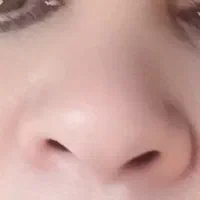 عمل بینی گوشتی راهنمایی