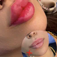 جشنواره آموزش ژل وبوتاکس ۱۰میلیون