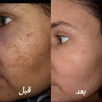 در افسریه ژل و فیلر مزوتراپی چربی سوز غبغب جوانساز|خدمات آرایشگری و زیبایی|تهران, افسریه شمالی|دیوار