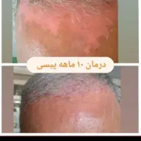 درمان قطعی وبدون بازگشت پوستی|آرایشی، بهداشتی، درمانی|سیرجان, |دیوار