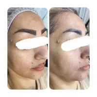 پاکسازی و فیشال پوست|خدمات آرایشگری و زیبایی|مشهد, امام رضا (ع)|دیوار