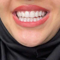 مدل کامپوزیت دندان|خدمات آرایشگری و زیبایی|تهران, شهر زیبا|دیوار