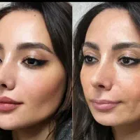 تزریق ژل بوتاکس و ساکشن تزریق چربی درکلینیک|خدمات آرایشگری و زیبایی|کرمانشاه, |دیوار