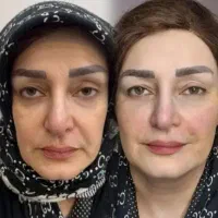 تخفیف کلینیک ژل بوتاکس نخ