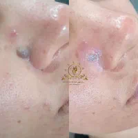 برداشتن خال سطحی ،گوشتی ،منگوله های بدن،میلیا