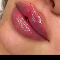 تزریق ژل و بوتاکس و اموزش